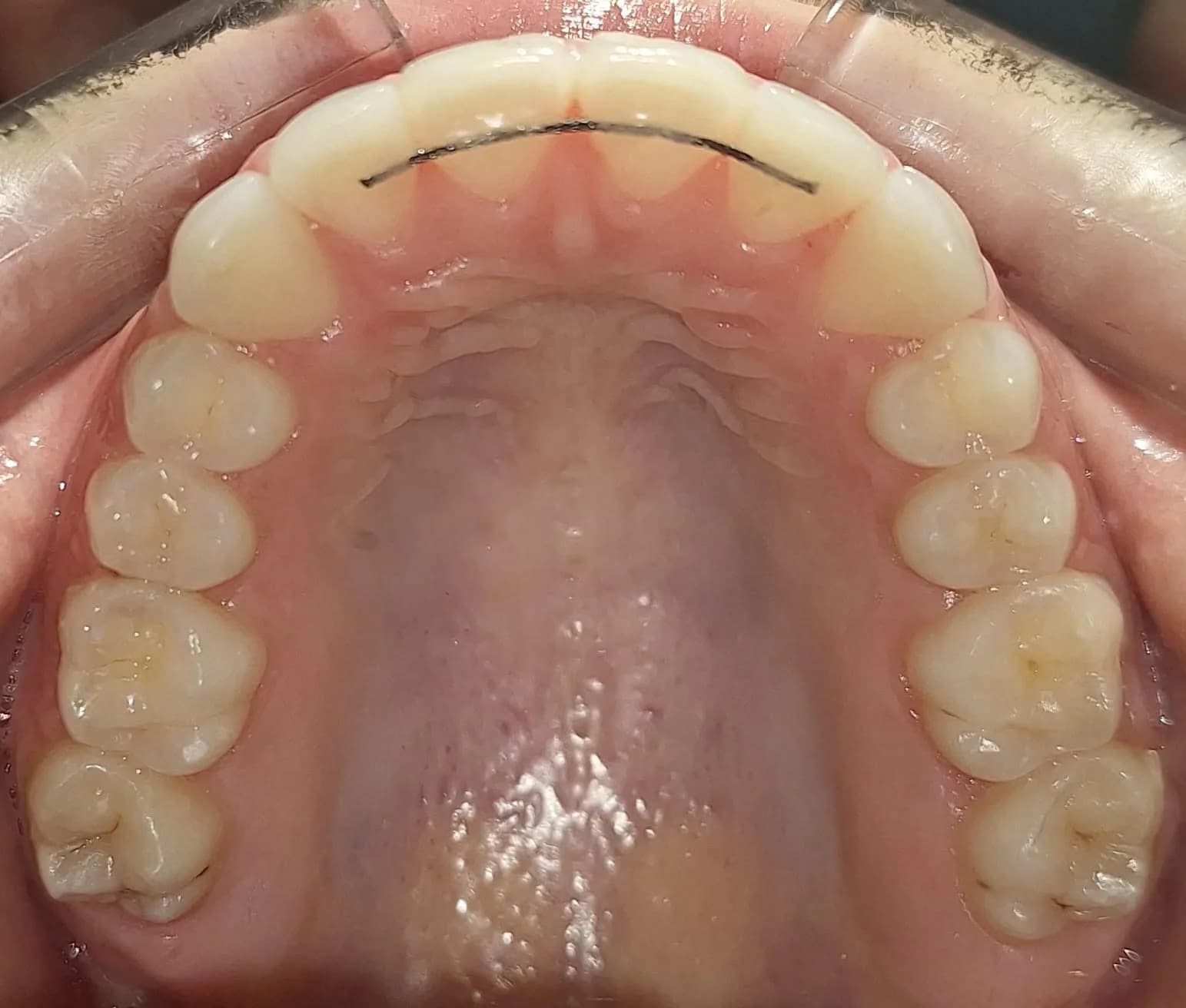 Evolución de la arcada dental, después