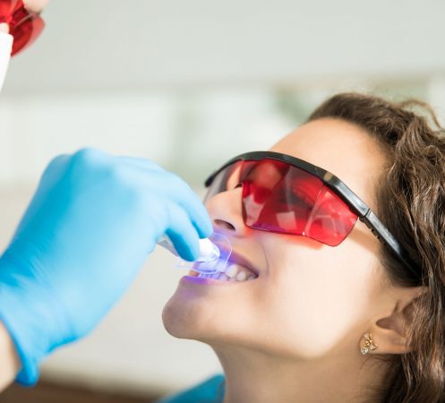 Closeup of young woman having her teeth whitened with ultraviolet light in a dental clinic